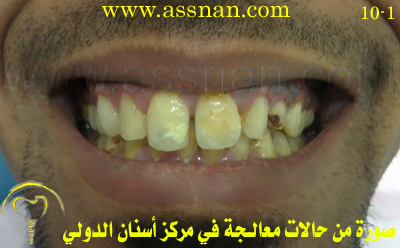صورة لأسنان مراجع يعاني من تباعد الأسنان قبل العلاج