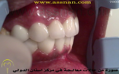 صورة جانبية لتركيبات الأسنان الزركونية بعد تعديل البروز