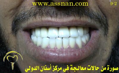 صورة لأسنان مراجع بعد تركيب تلبيسات وجسور الزيركون من أجل تصحيح تقدم الفك السفلي
