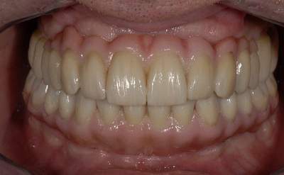 الفكين السفلي والعلوي بعد تركيب الأسنان الزيركونية خلال 10 ايام