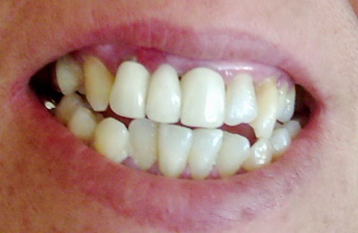جسر أمامي ثلاثة قطع لاحظ التهابات اللثة والأسنان الغير متناسقة والغير متناسقة من ناحية اللون والحجم و الارتفاع مع الأسنان الثانية  