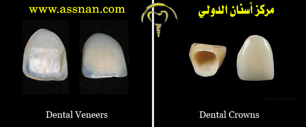 ما هي تركيبات اللومينير أو عدسات الأسنان و الفينير أو القشرة وما هو الفرق  بينهما
