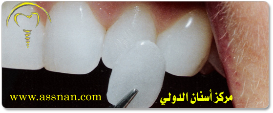 ما هي تركيبات اللومينير أو عدسات الأسنان و الفينير أو القشرة وما هو الفرق  بينهما