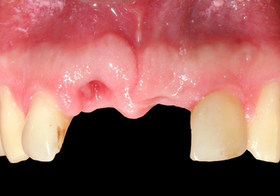 الأسنان قبل عملية الزرع